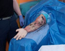 Right Escharotomy Arm<